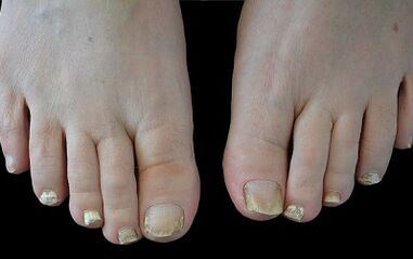 Cum să scapi de ciuperca de pe degete