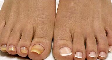 Metode de tratare a ciupercilor cu flotă