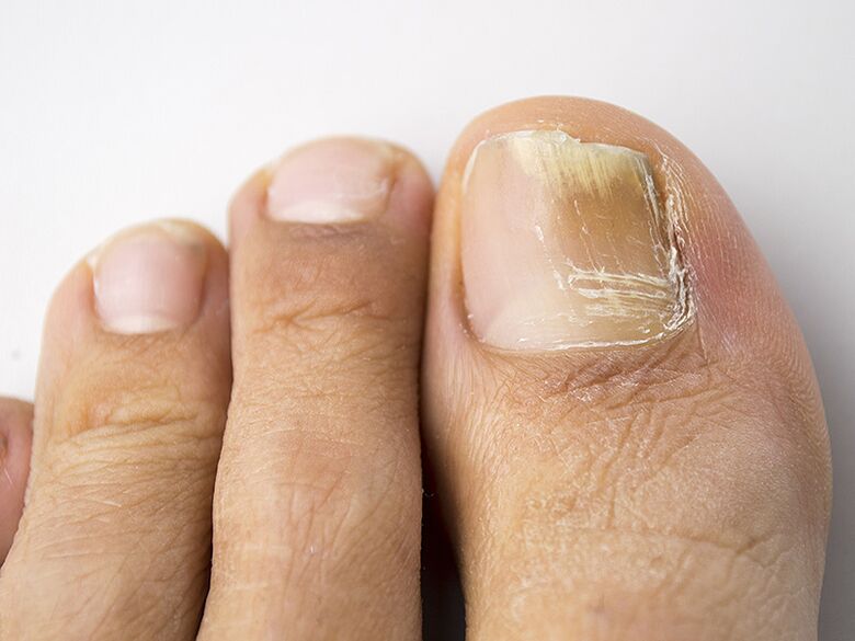 Etapa inițială a ciupercii