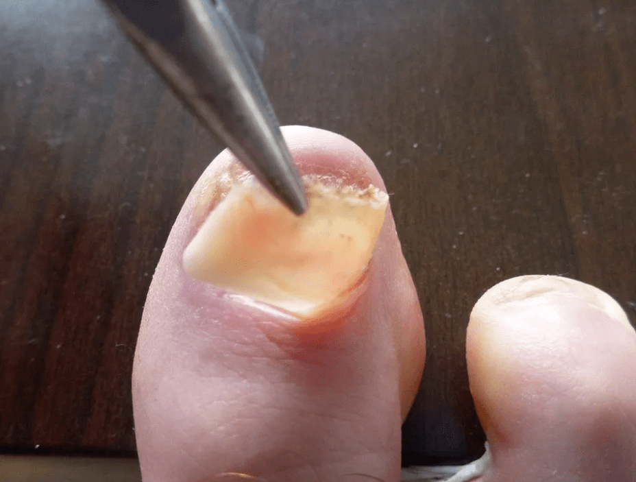 Îndepărtarea plăcii