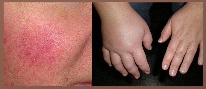 Efecte secundare ale picăturilor